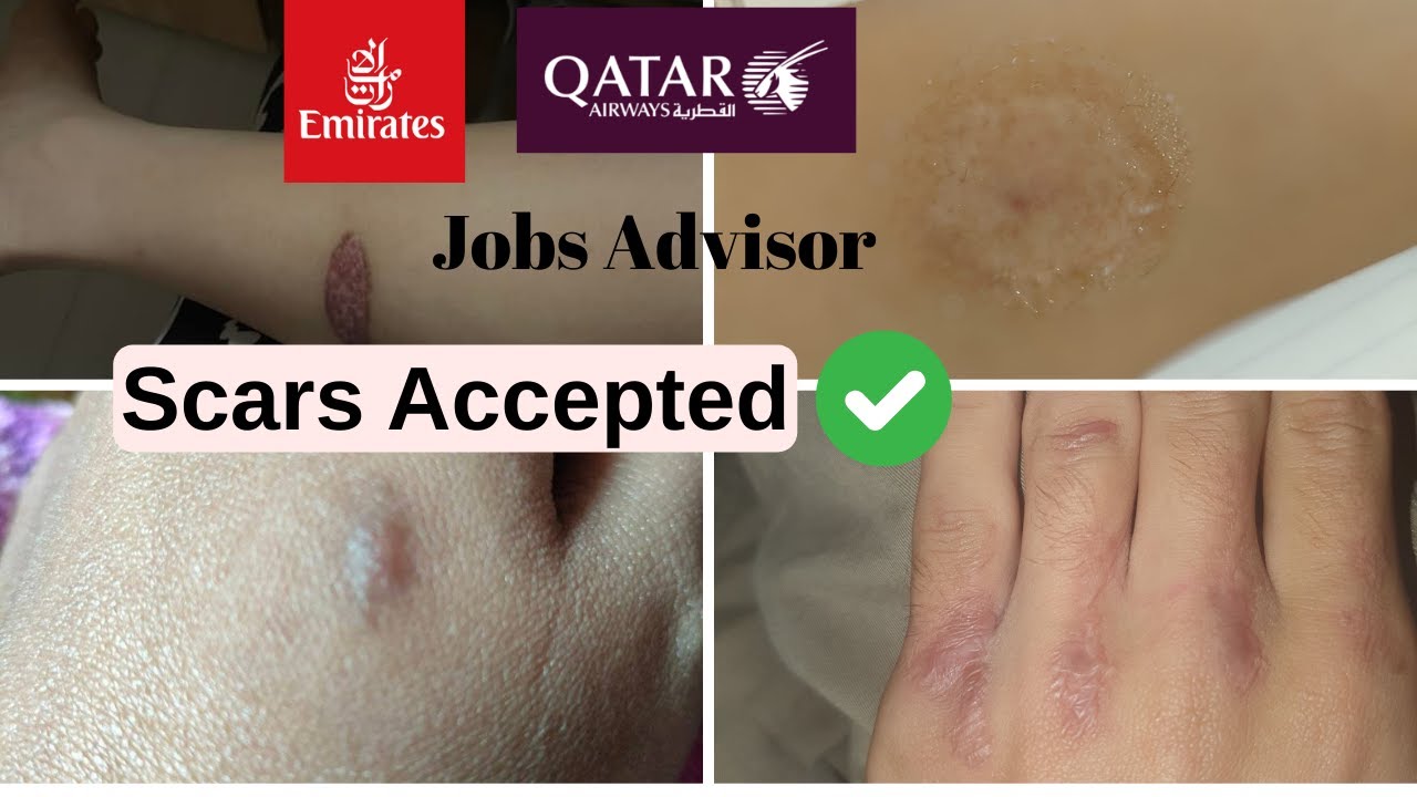 Scars Accepted? Emirates Cabin Crew Requirements Explained!
