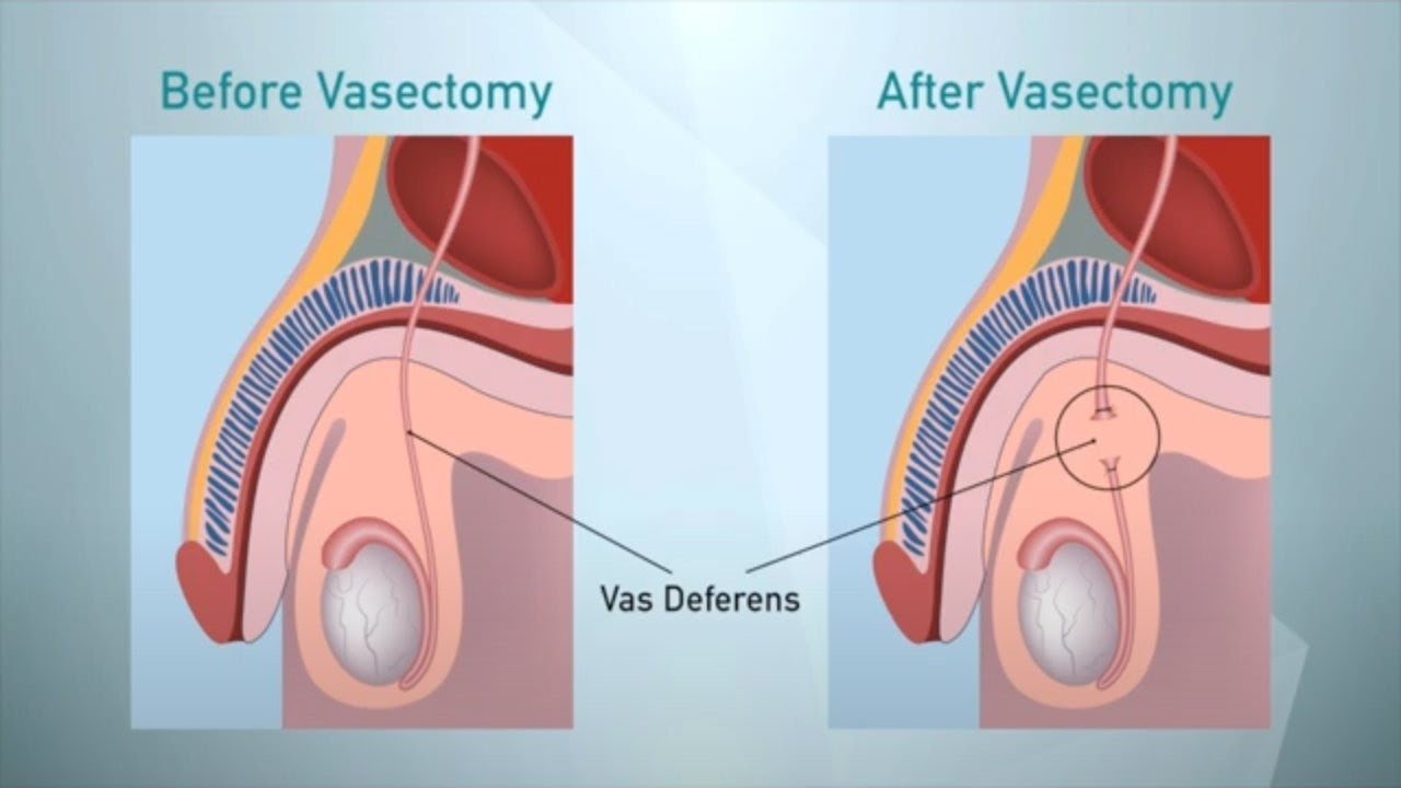 Vasectomy Consultation - What You Need to Know When Considering a Vasectomy
