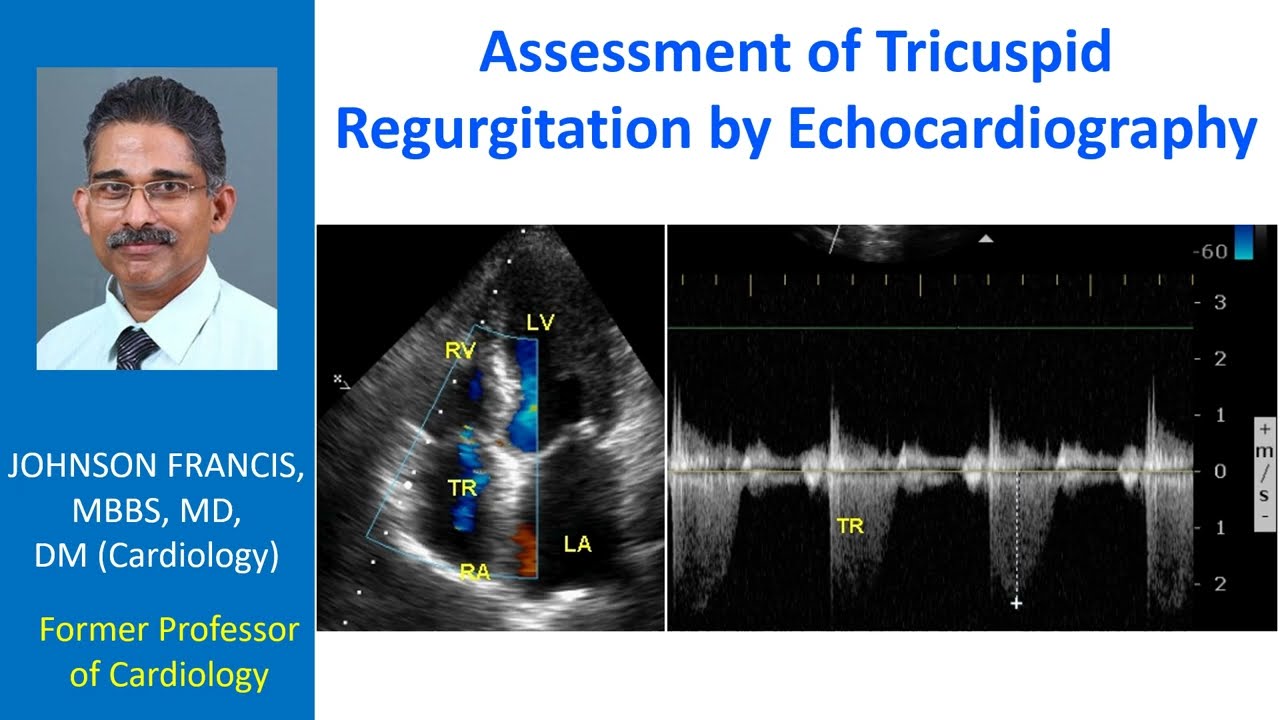 Assessment of Tricuspid Regurgitation by Echocardiography
