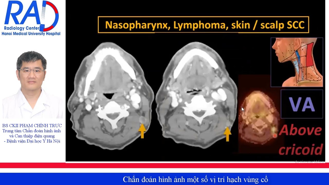 CHẨN ĐOÁN HÌNH ẢNH MỘT SỐ VỊ TRÍ HẠCH VÙNG CỔ