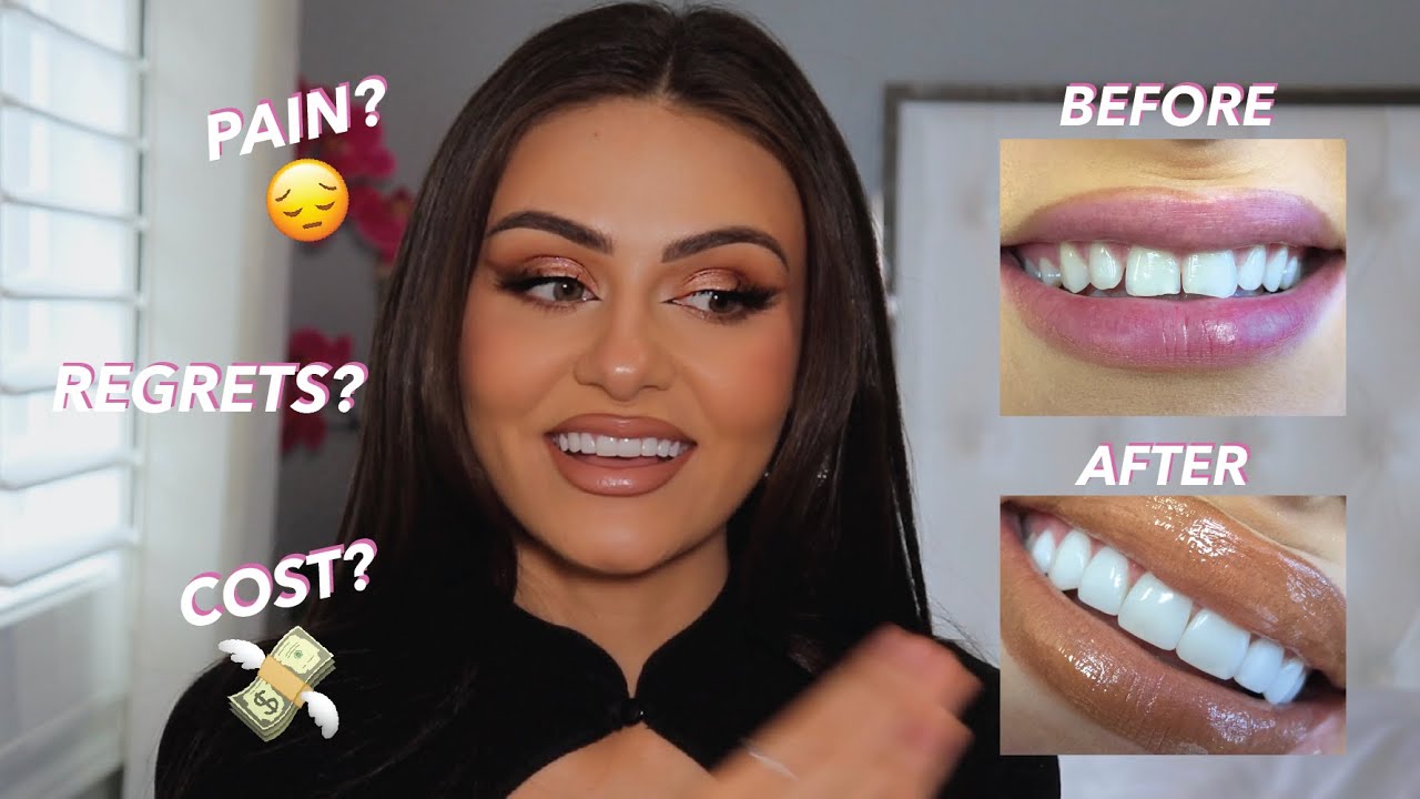 MY EXPERIENCE WITH COMPOSITE VENEERS | TORONTO