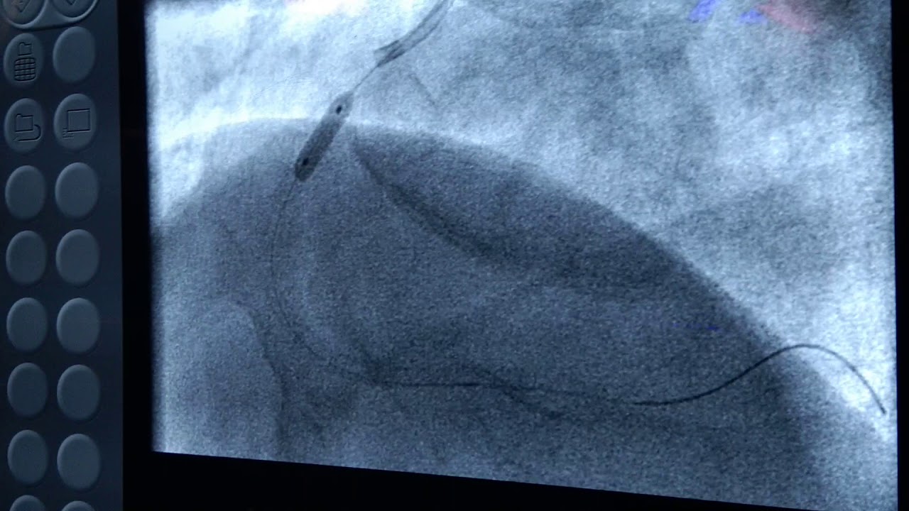 Complex Angioplasty with two long stents in right coronary artery
