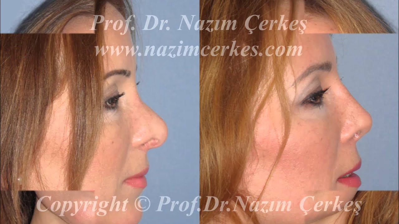 REVİZYON BURUN ESTETİĞİ PROF DR NAZIM ÇERKEŞ