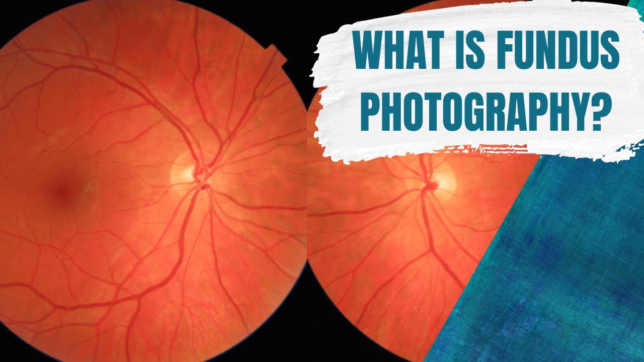 What is fundus photography?