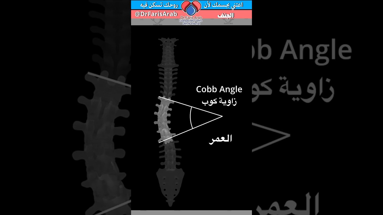 كيفية فحص الجنف في المنزل