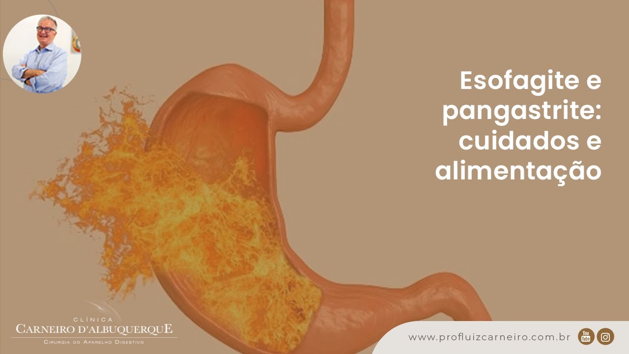 Esofagite e pangastrite: cuidados e alimentação | Prof. Dr. Luiz Carneiro CRM 22761