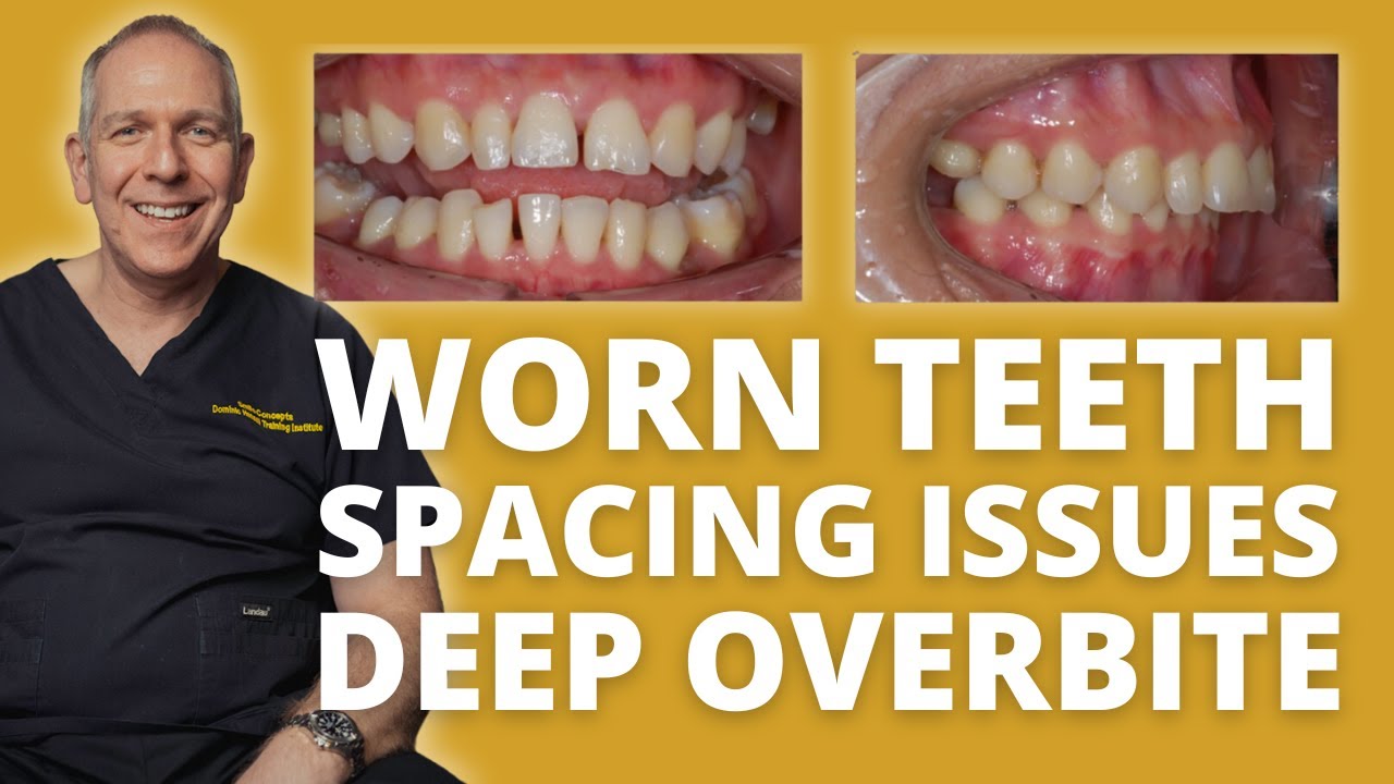 Dentistry Case: Poor Aesthetics with Deep Overbite and Traumatic Occlusion