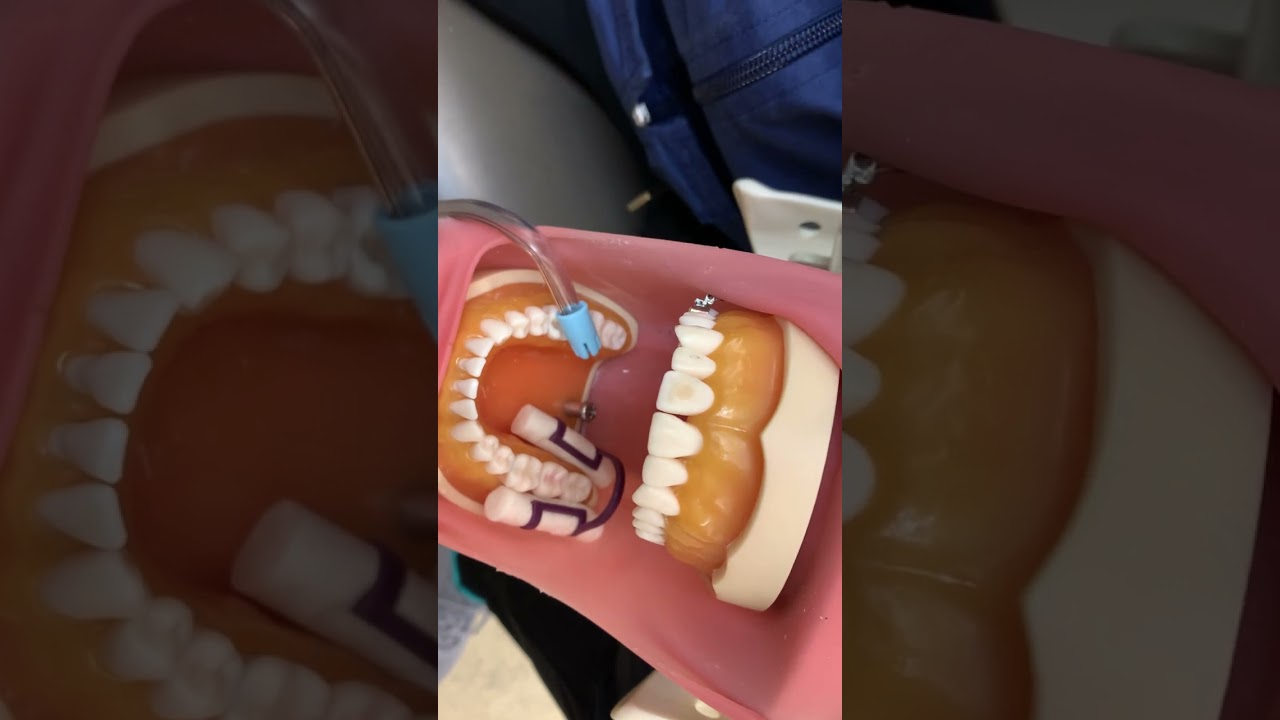 Pit & Fissure Sealant Video