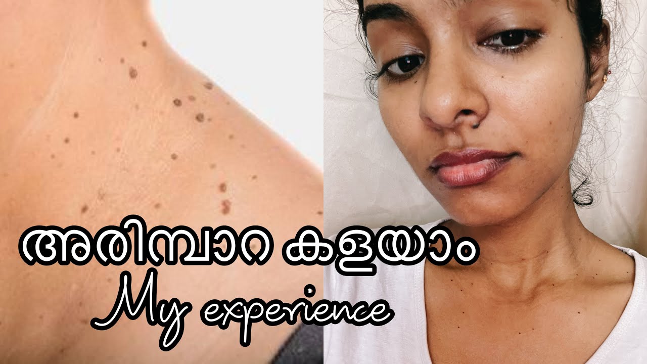 അരിമ്പാറ, കാക്കപ്പുള്ളി, പാലുണ്ണി ഇല്ലാതാക്കാം|My Warts Removal Laser Treatment experience | Asvi