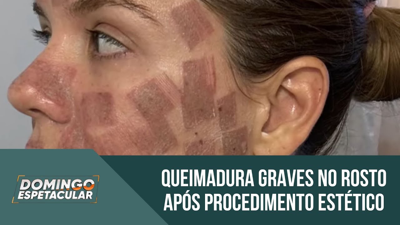 Pacientes modelo sofrem queimaduras graves durante procedimento estético com laser de CO2