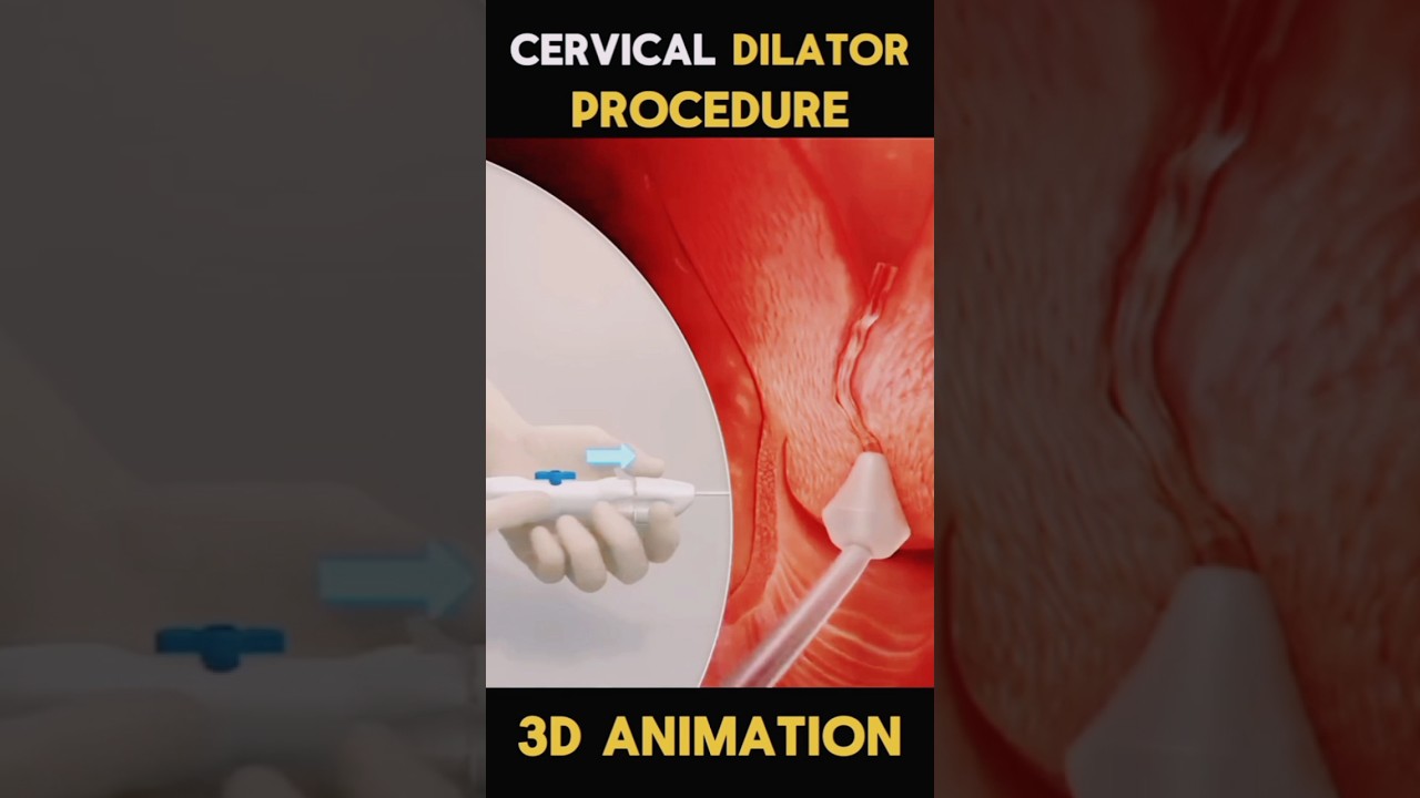Cervical Dilator Procedures #short #viral #trending #cervax #surgeon