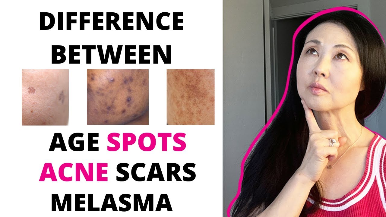 Difference Between Acne scars, Age Spots and Melasma #melasmatreatment #goseechristy