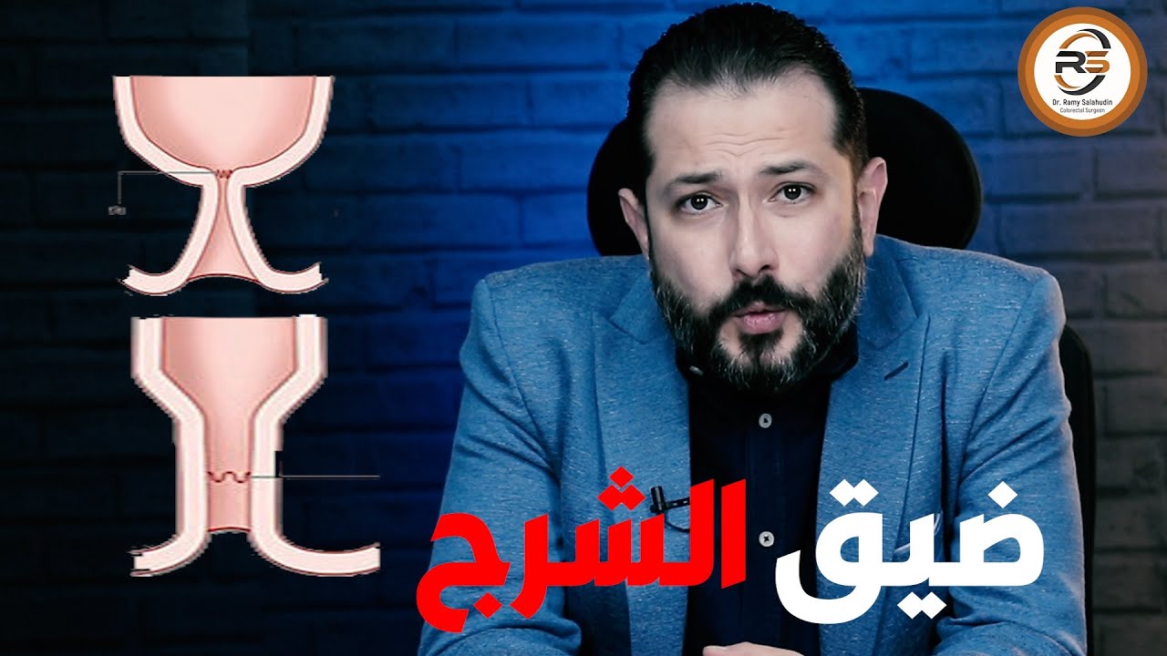 ايه هو ضيق الشرج و أهم أسبابة و طرق علاجة مع د #رامي_صلاح_الدين