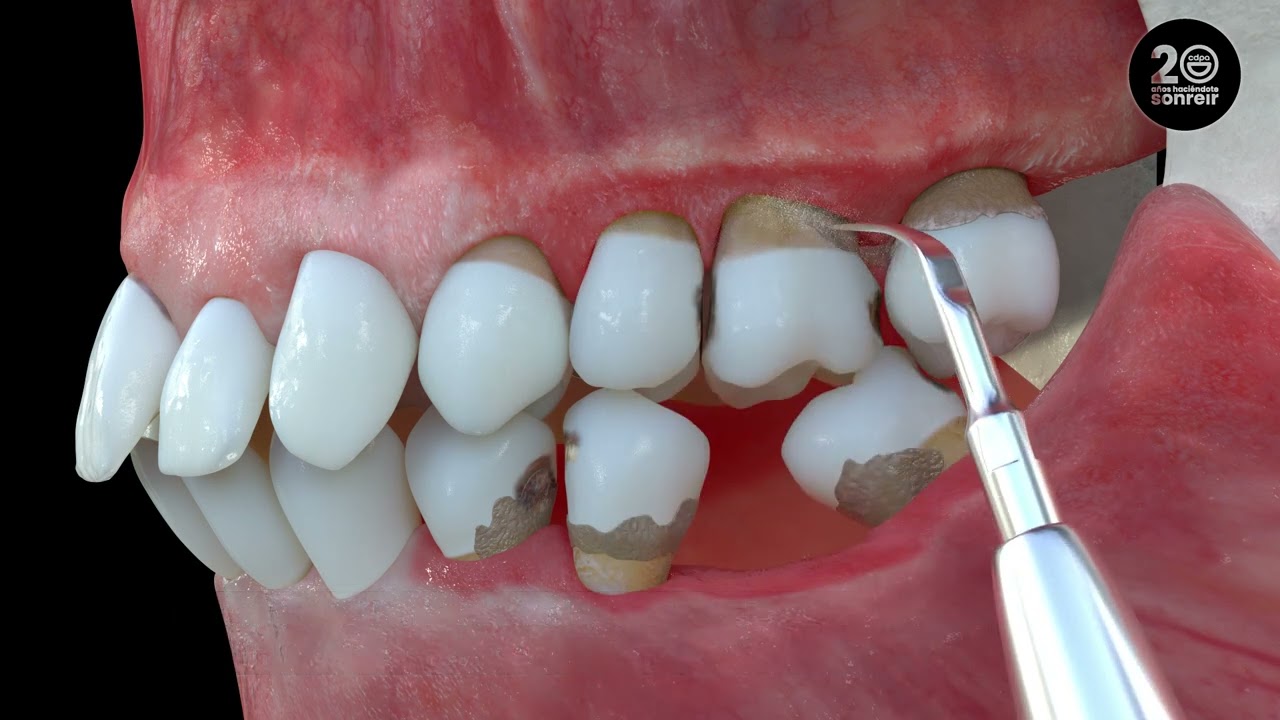 Consecuencias Ausencia Dental - Clínica Dental Patricia Aneiros