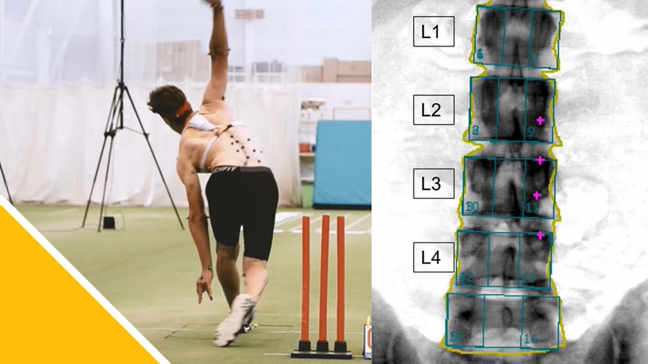 Cricket Fast Bowling and the Lumbar Spine | Dr Pete Alway