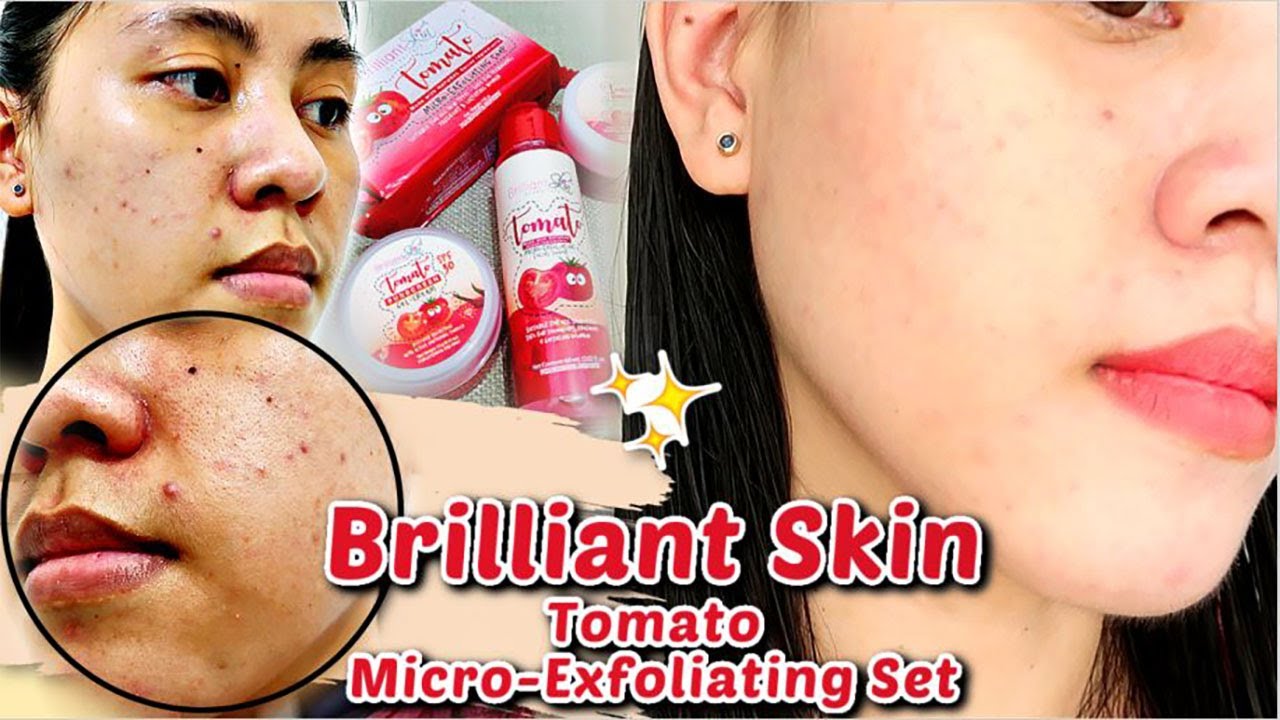 BRILLIANT SKIN TOMATO EXFOLIATING/REJUVENATING SET 5DAYS REVIEW (NAGKA-PIMPLES!!) | SteffiRayVlogs🌻