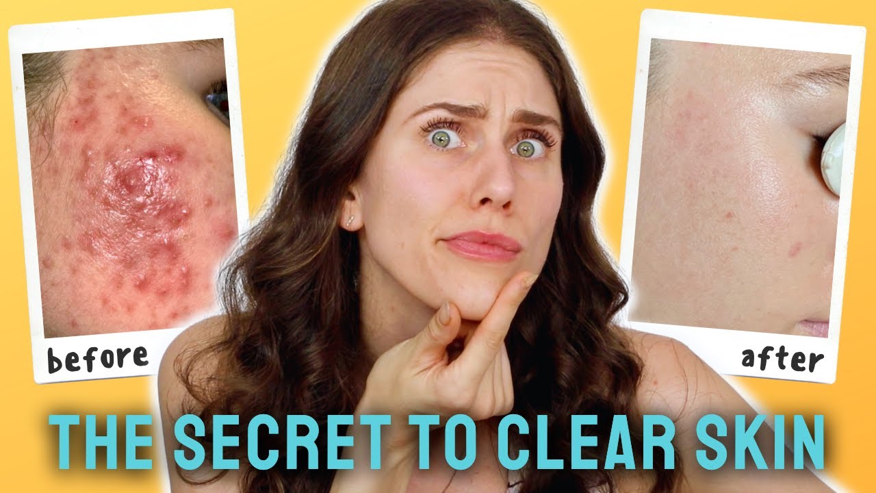 5 Ways Estheticians Treat Acne - Acne Certification With Face Reality Acne Clinic