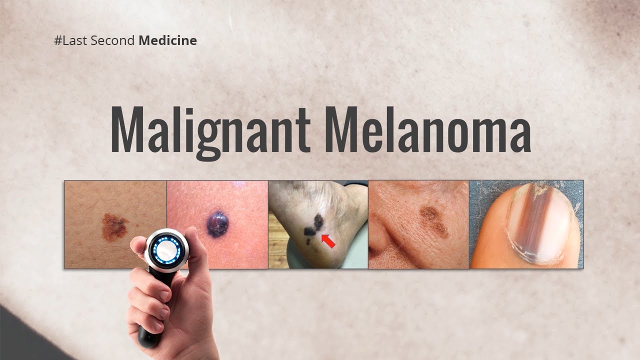 Malignant Melanoma