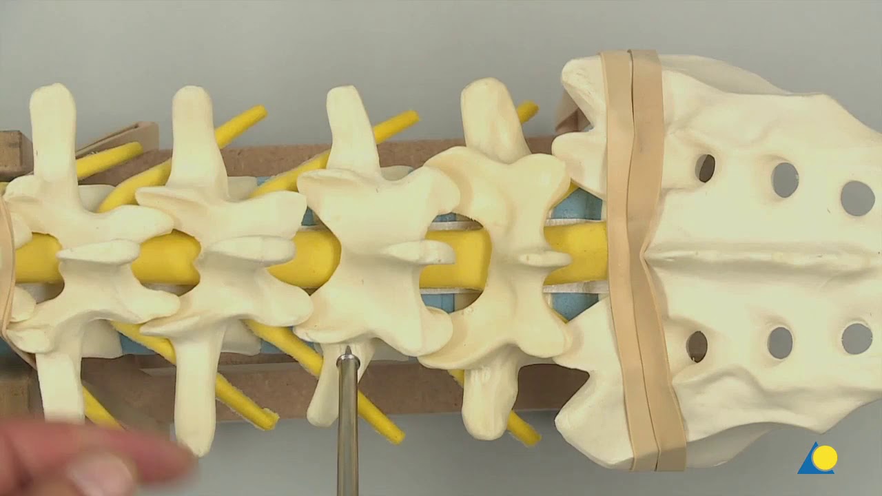 Lumbar Fusion using Expedium 5 5