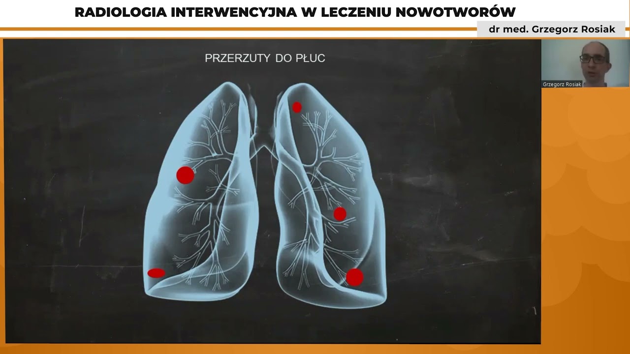 Radiologia interwencyjna w leczeniu nowotwor&oacute;w.