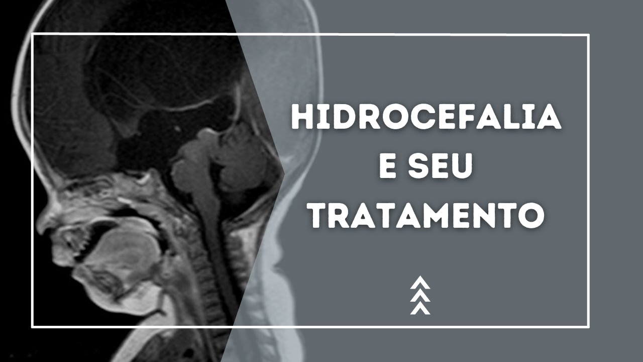Hidrocefalia e seu tratamento