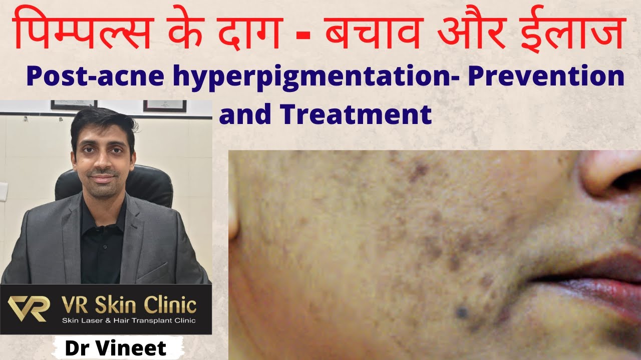पिम्पल्स के दाग से पाएं छुटकारा -Get rid of post acne hyperpigmentation | VR Skin Clinic | Dr Vineet