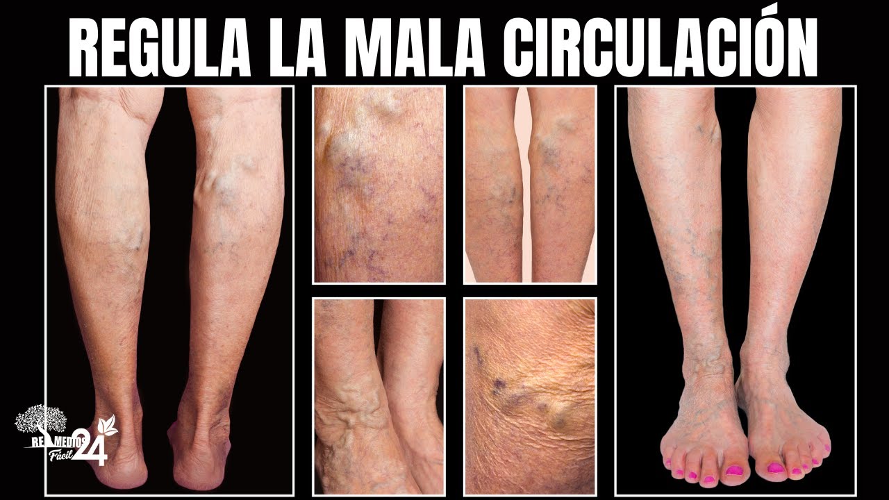 🔥❤ SANGRE ESPESA O GRUESA, Remedio Natural para Diluirla sin Pastilla - POLIGLOBULIA