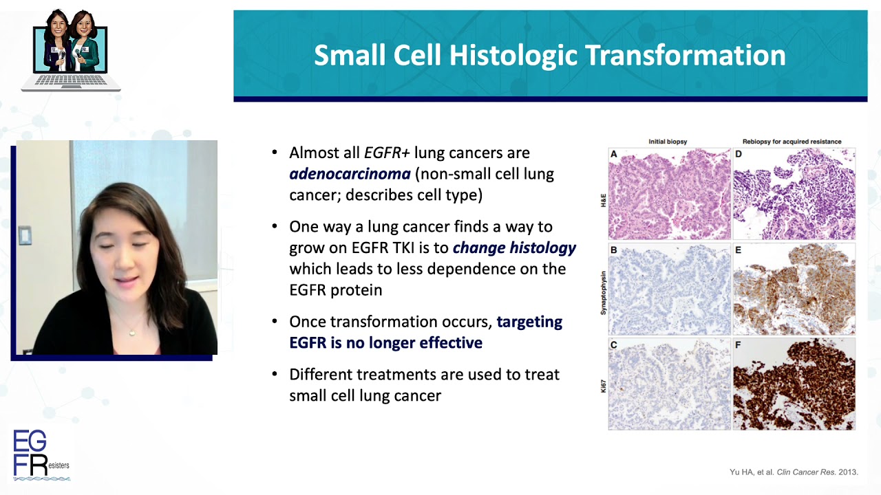 Ask the Experts: What is Histological Transformation, and Can it Be Treated?