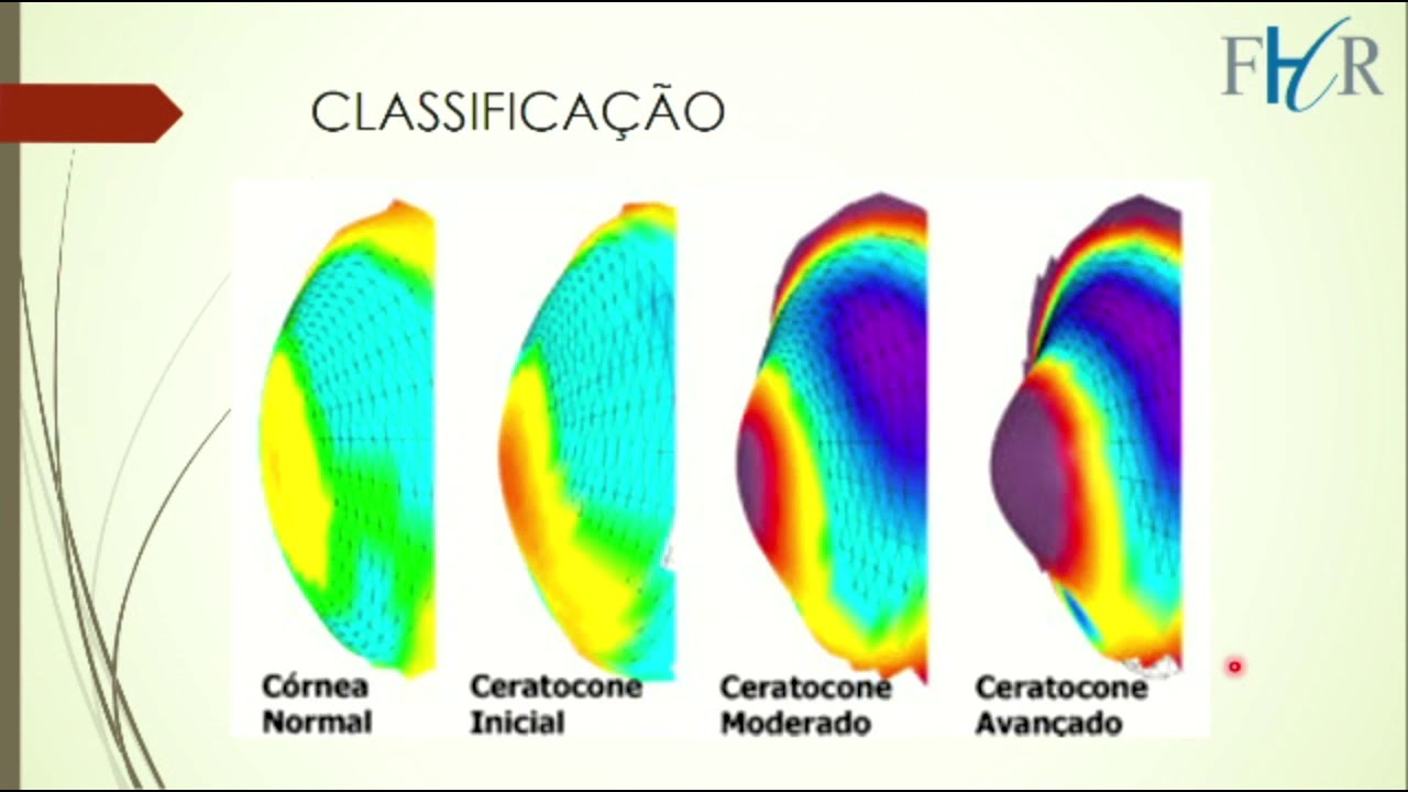 Ceratocone - Dra. Tassiana Malagole (E1-FHR) 2020
