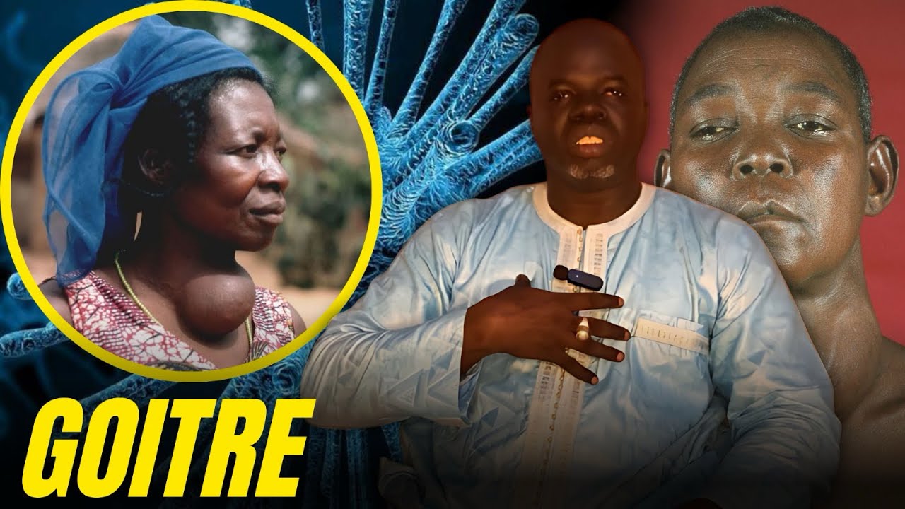Goitre #1 - ( Causes et Conséquences ) - Pr Ousmane Ndiaye - SAMA XALAAT TV