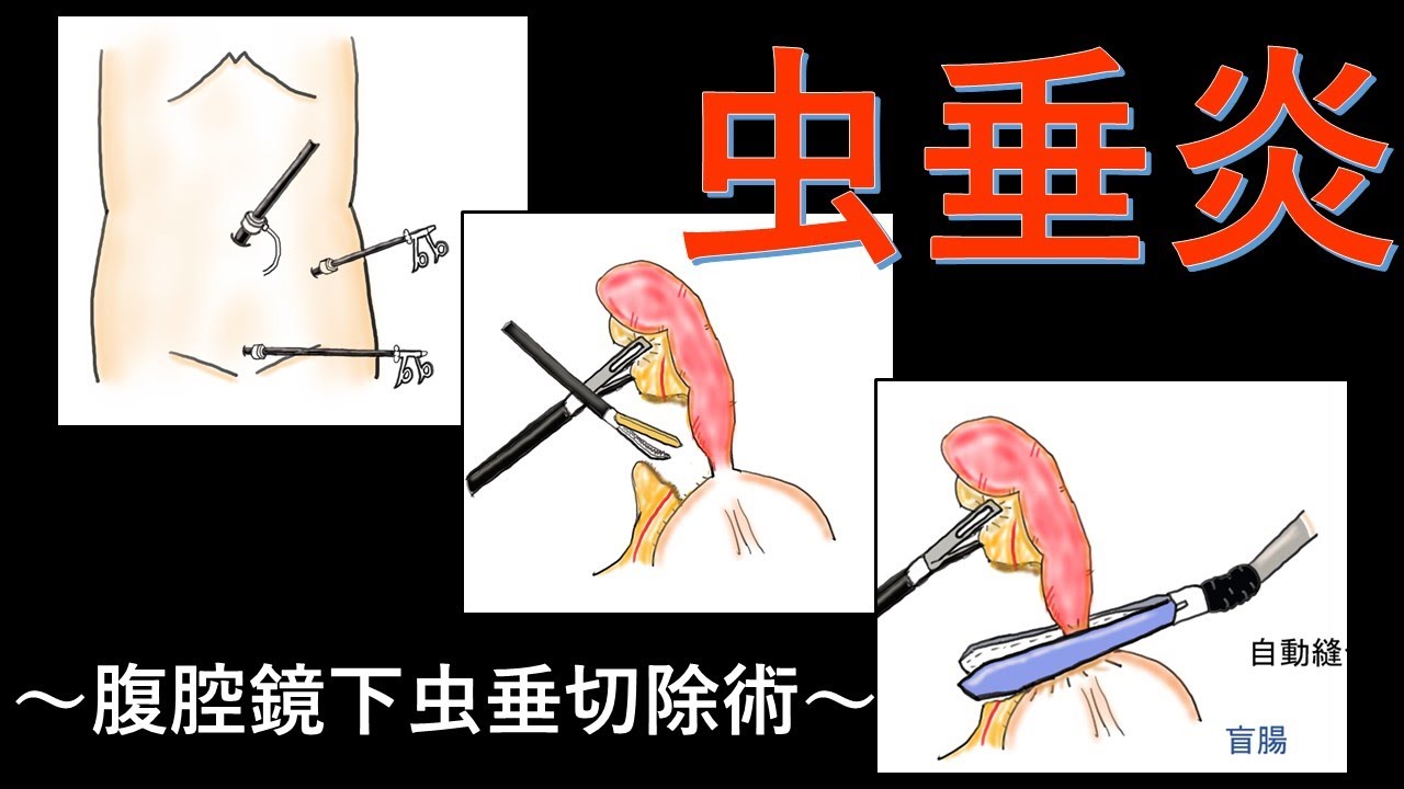 これだけ知っていればOK、腹腔鏡下虫垂切除術のメリット、デメリット【医師解説】