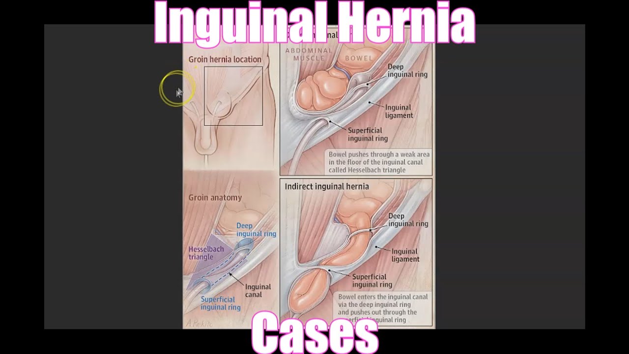 Inguinal Hernia Cases