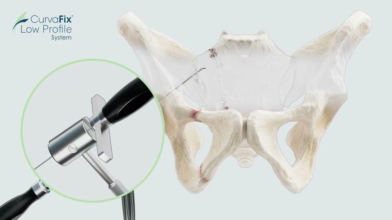 CurvaFix LP Surgical Animation