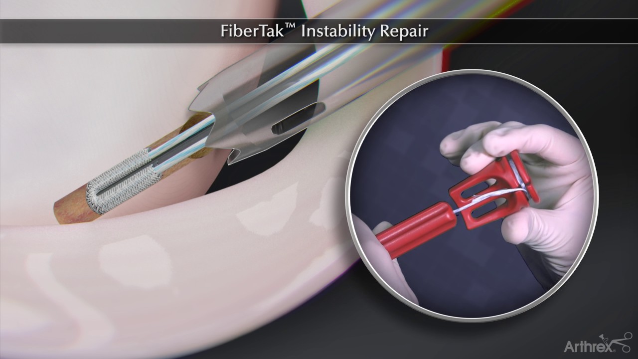 FiberTak™ Instability Repair
