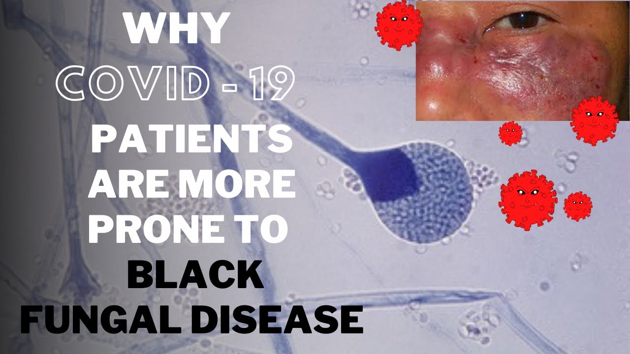 CoVID 19 recovered patient stay alert for Black fungus / Mucormycosis, a deadly fungal disease.