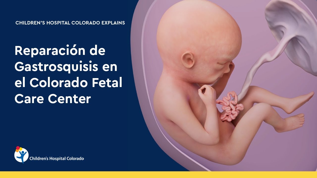 Reparación de gastrosquisis en el Colorado Fetal Care Center