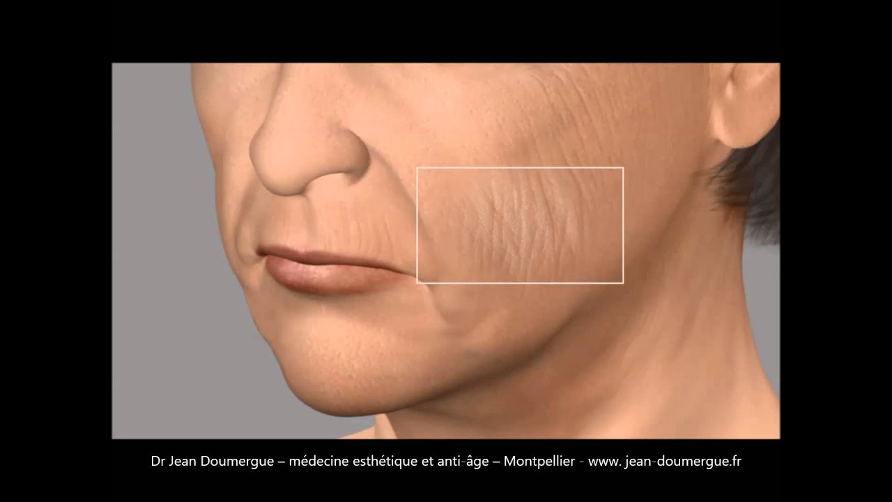 Rides et aspect fripé du visage: Dr Jean Doumergue médecine esthétique et anti-âge à Montpellier