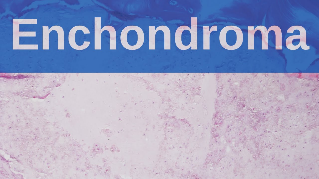 What are Enchondromas? - Pathology mini tutorial