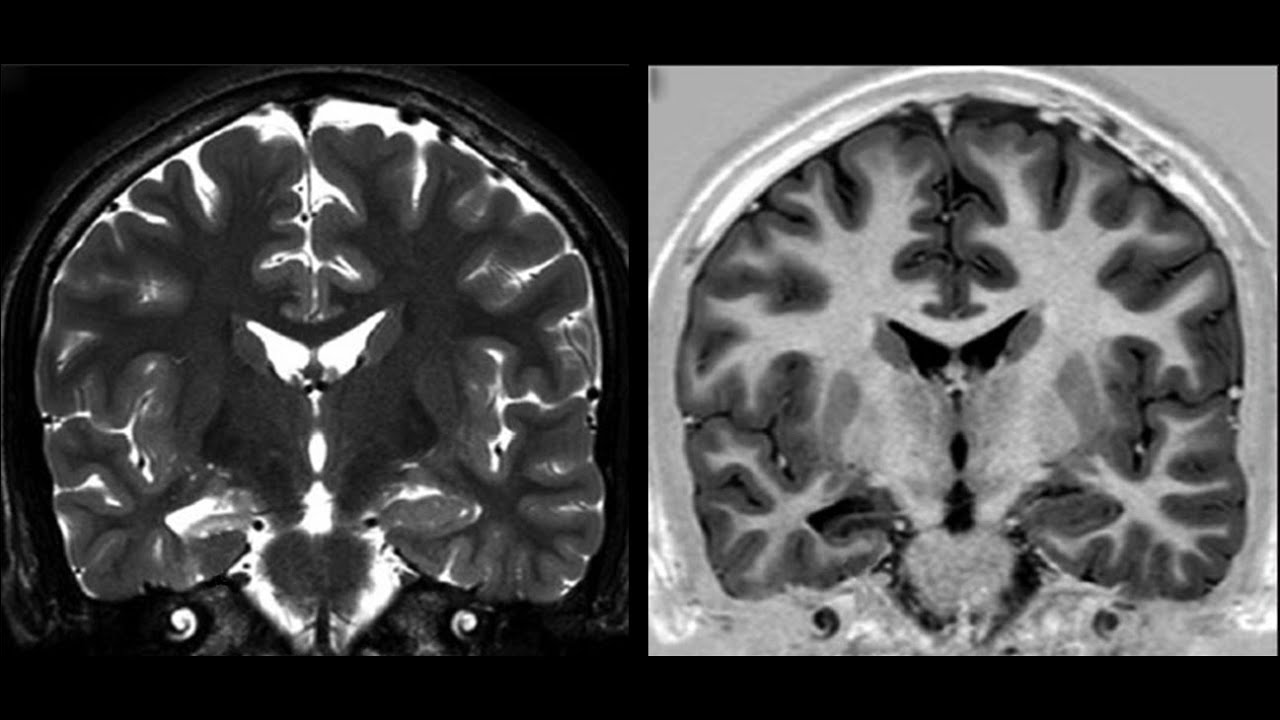 Esclerose mesial temporal