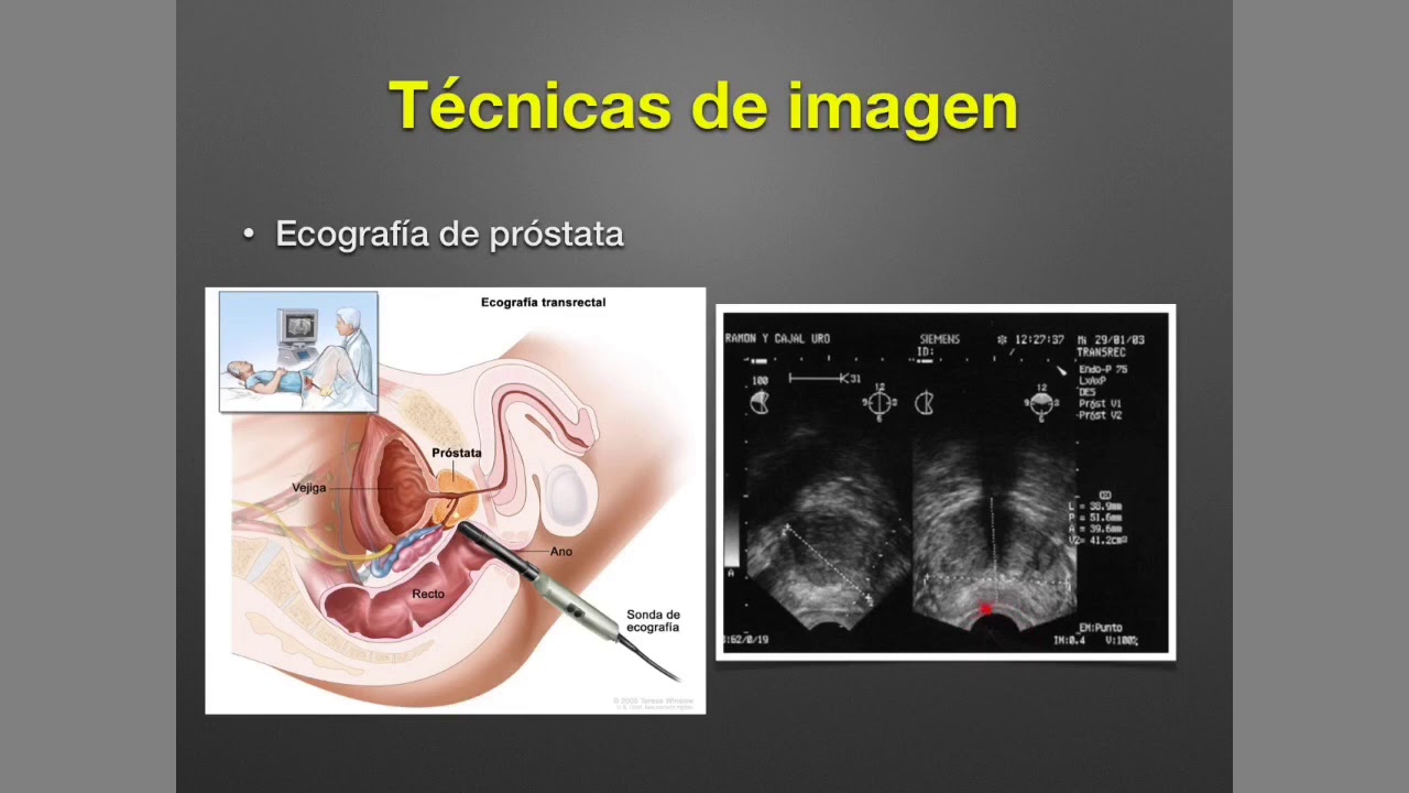 Hipertrofia prostática benigna