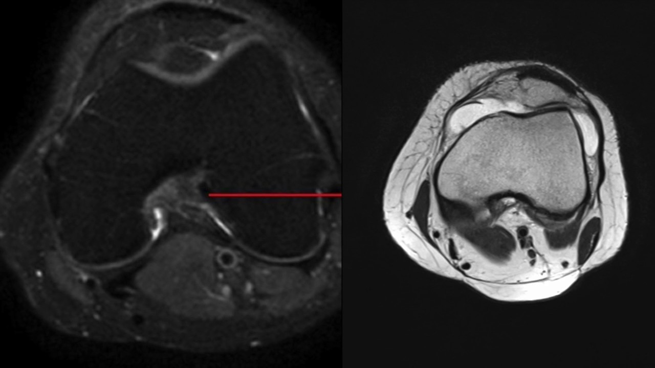 TMT: MRI of ACL tears by Dr Srijita Ghosh