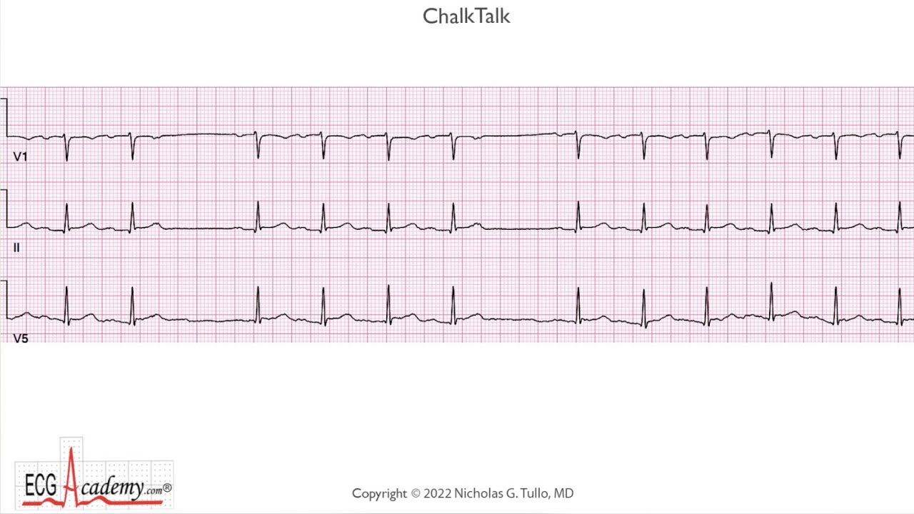 ECG Academy ChalkTalk Coaching #517