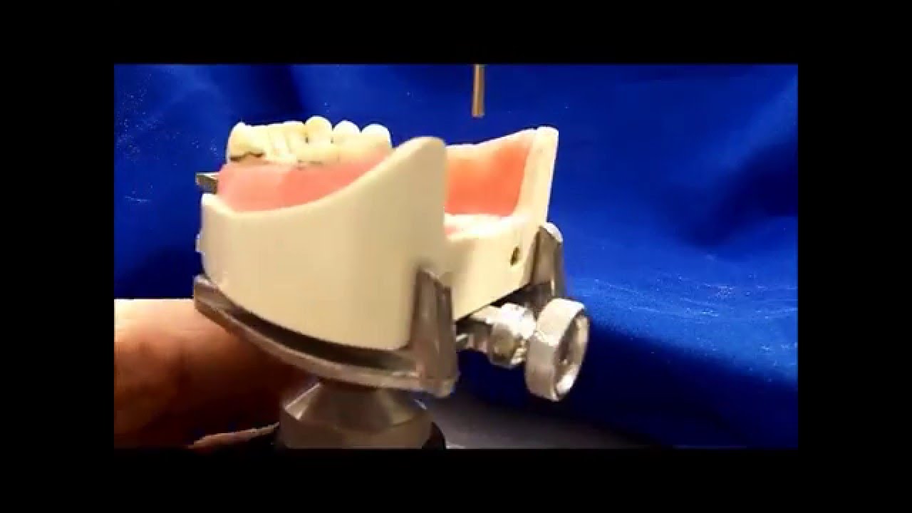 RPD Tooth Preparation Exercise