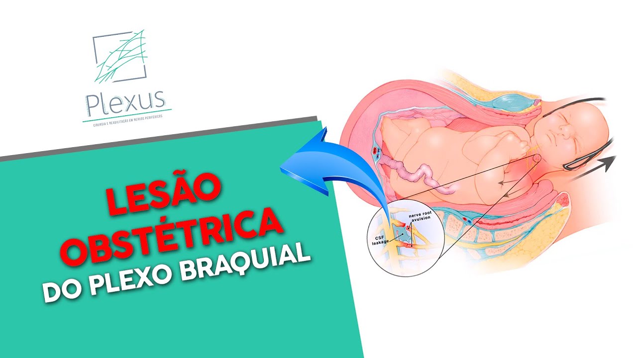 Lesão Obstétrica do Plexo Braquial
