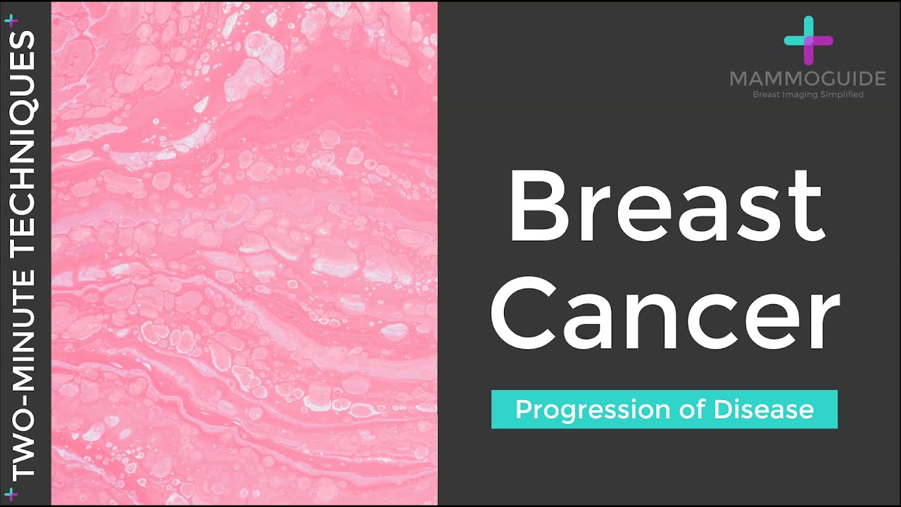 Two Minute Techniques - Breast Cancer Progression