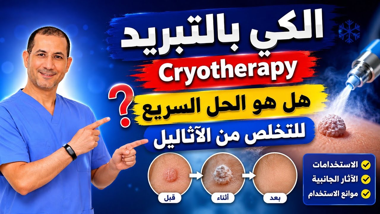 الكي بالتبريد: استخدماته والآثار الجانبية وموانع استخدامه cryotherapy #د_سامح_البكري