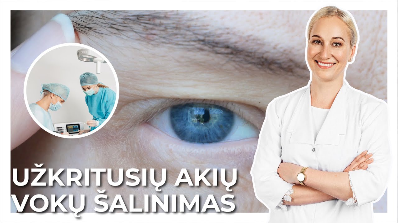 Užkritusių vokų šalinimas | Med.m.dr., doc. R. Liutkevičienė