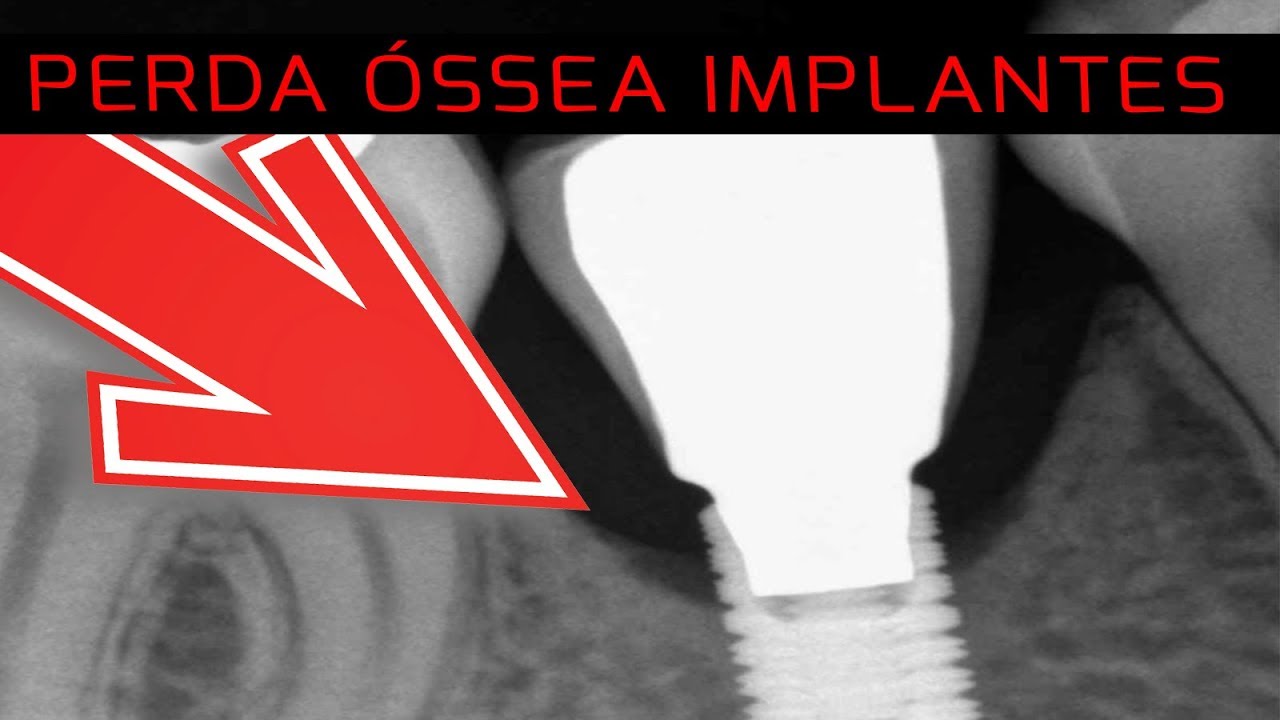 (Ep 12) Perda Óssea Precoce em Implantes Dentários