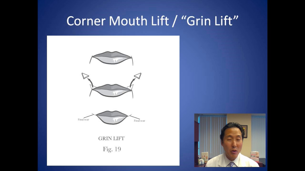 How Can I Fix My Permanent Frown - Corner Mouth Lift Consultation - Dr. Anthony Youn