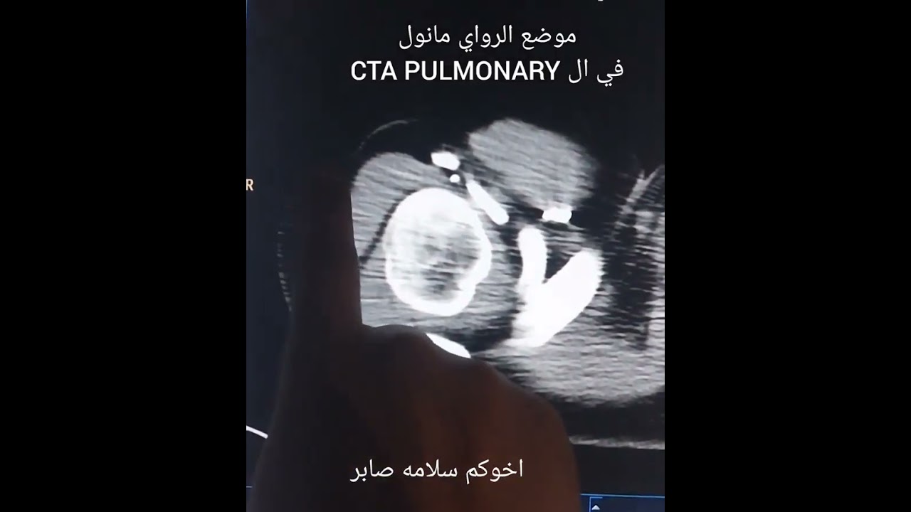 موضع ال ROI يدوي في المقطعيه علي الشريان الرئوي